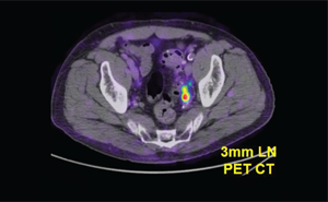 A SMALL TUMOR DETECTED BY THE THERAGNOSTICS PROSTATE CANCER AGENT IN A CLINICAL TRIAL