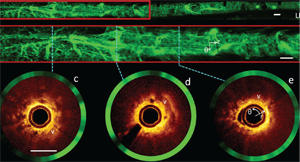 IMAGES FROM A HUMAN AIRWAY ACqUIRED BY A FIBER-OPTIC IMAGING CATHETER AND SYSTEM DEVELOPED IN LANE’S LAB. THE TWO OPTICAL IMAGING MODALITIES USED HAVE EACH SHOWN PROMISE FOR THE EARLY DETECTION OF LUNG CANCER.